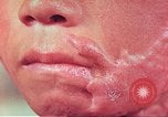 Image of skin wounds from atomic bomb burn Hiroshima Japan, 1946, second 19 stock footage video 65675060693