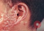 Image of skin wounds from atomic bomb burn Hiroshima Japan, 1946, second 21 stock footage video 65675060693
