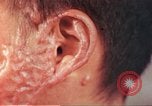 Image of skin wounds from atomic bomb burn Hiroshima Japan, 1946, second 22 stock footage video 65675060693