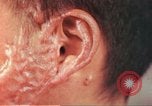 Image of skin wounds from atomic bomb burn Hiroshima Japan, 1946, second 23 stock footage video 65675060693