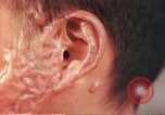 Image of skin wounds from atomic bomb burn Hiroshima Japan, 1946, second 24 stock footage video 65675060693