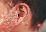 Image of skin wounds from atomic bomb burn Hiroshima Japan, 1946, second 25 stock footage video 65675060693