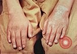 Image of skin wounds from atomic bomb burn Hiroshima Japan, 1946, second 28 stock footage video 65675060693