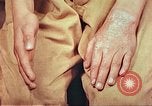 Image of skin wounds from atomic bomb burn Hiroshima Japan, 1946, second 29 stock footage video 65675060693