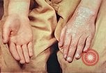 Image of skin wounds from atomic bomb burn Hiroshima Japan, 1946, second 30 stock footage video 65675060693