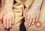 Image of skin wounds from atomic bomb burn Hiroshima Japan, 1946, second 31 stock footage video 65675060693