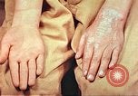 Image of skin wounds from atomic bomb burn Hiroshima Japan, 1946, second 32 stock footage video 65675060693