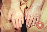Image of skin wounds from atomic bomb burn Hiroshima Japan, 1946, second 33 stock footage video 65675060693