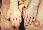 Image of skin wounds from atomic bomb burn Hiroshima Japan, 1946, second 35 stock footage video 65675060693