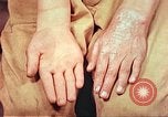 Image of skin wounds from atomic bomb burn Hiroshima Japan, 1946, second 36 stock footage video 65675060693