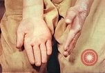 Image of skin wounds from atomic bomb burn Hiroshima Japan, 1946, second 37 stock footage video 65675060693