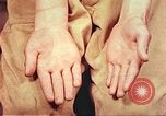 Image of skin wounds from atomic bomb burn Hiroshima Japan, 1946, second 38 stock footage video 65675060693