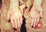 Image of skin wounds from atomic bomb burn Hiroshima Japan, 1946, second 39 stock footage video 65675060693