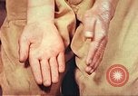 Image of skin wounds from atomic bomb burn Hiroshima Japan, 1946, second 40 stock footage video 65675060693