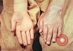 Image of skin wounds from atomic bomb burn Hiroshima Japan, 1946, second 42 stock footage video 65675060693