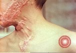 Image of skin wounds from atomic bomb burn Hiroshima Japan, 1946, second 43 stock footage video 65675060693