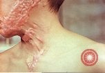 Image of skin wounds from atomic bomb burn Hiroshima Japan, 1946, second 44 stock footage video 65675060693
