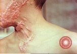 Image of skin wounds from atomic bomb burn Hiroshima Japan, 1946, second 48 stock footage video 65675060693