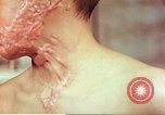 Image of skin wounds from atomic bomb burn Hiroshima Japan, 1946, second 49 stock footage video 65675060693