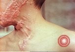 Image of skin wounds from atomic bomb burn Hiroshima Japan, 1946, second 50 stock footage video 65675060693