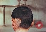 Image of Japanese atomic bomb victim wounds Hiroshima Japan, 1946, second 3 stock footage video 65675060694