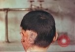 Image of Japanese atomic bomb victim wounds Hiroshima Japan, 1946, second 4 stock footage video 65675060694