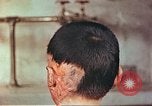 Image of Japanese atomic bomb victim wounds Hiroshima Japan, 1946, second 5 stock footage video 65675060694