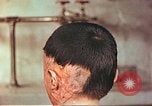 Image of Japanese atomic bomb victim wounds Hiroshima Japan, 1946, second 6 stock footage video 65675060694