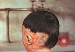 Image of Japanese atomic bomb victim wounds Hiroshima Japan, 1946, second 7 stock footage video 65675060694