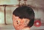 Image of Japanese atomic bomb victim wounds Hiroshima Japan, 1946, second 8 stock footage video 65675060694