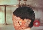 Image of Japanese atomic bomb victim wounds Hiroshima Japan, 1946, second 9 stock footage video 65675060694
