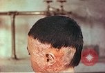 Image of Japanese atomic bomb victim wounds Hiroshima Japan, 1946, second 10 stock footage video 65675060694
