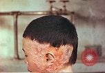 Image of Japanese atomic bomb victim wounds Hiroshima Japan, 1946, second 11 stock footage video 65675060694