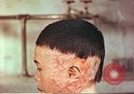 Image of Japanese atomic bomb victim wounds Hiroshima Japan, 1946, second 12 stock footage video 65675060694