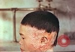 Image of Japanese atomic bomb victim wounds Hiroshima Japan, 1946, second 13 stock footage video 65675060694