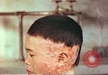 Image of Japanese atomic bomb victim wounds Hiroshima Japan, 1946, second 14 stock footage video 65675060694
