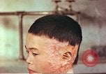 Image of Japanese atomic bomb victim wounds Hiroshima Japan, 1946, second 15 stock footage video 65675060694
