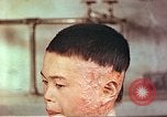Image of Japanese atomic bomb victim wounds Hiroshima Japan, 1946, second 16 stock footage video 65675060694