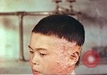 Image of Japanese atomic bomb victim wounds Hiroshima Japan, 1946, second 17 stock footage video 65675060694