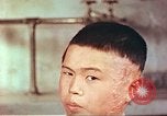 Image of Japanese atomic bomb victim wounds Hiroshima Japan, 1946, second 18 stock footage video 65675060694