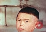 Image of Japanese atomic bomb victim wounds Hiroshima Japan, 1946, second 19 stock footage video 65675060694