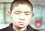 Image of clothing lines on atomic bomb burn victim Hiroshima Japan, 1946, second 8 stock footage video 65675060696