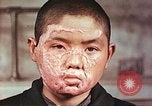 Image of clothing lines on atomic bomb burn victim Hiroshima Japan, 1946, second 9 stock footage video 65675060696