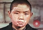 Image of clothing lines on atomic bomb burn victim Hiroshima Japan, 1946, second 10 stock footage video 65675060696