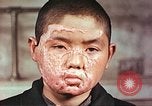 Image of clothing lines on atomic bomb burn victim Hiroshima Japan, 1946, second 11 stock footage video 65675060696