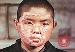 Image of clothing lines on atomic bomb burn victim Hiroshima Japan, 1946, second 12 stock footage video 65675060696