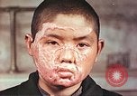 Image of clothing lines on atomic bomb burn victim Hiroshima Japan, 1946, second 13 stock footage video 65675060696