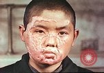 Image of clothing lines on atomic bomb burn victim Hiroshima Japan, 1946, second 14 stock footage video 65675060696