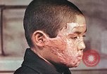 Image of clothing lines on atomic bomb burn victim Hiroshima Japan, 1946, second 15 stock footage video 65675060696