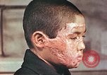 Image of clothing lines on atomic bomb burn victim Hiroshima Japan, 1946, second 16 stock footage video 65675060696